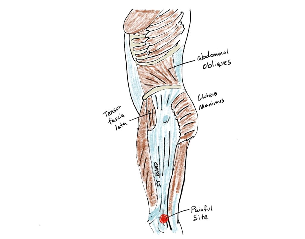 How I Cured My IT Band Syndrome - Rincon Chiropractic