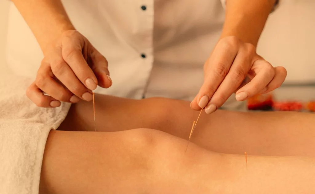 Acupuncturist working on patient with IT Band Syndrome